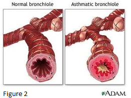 asthma change lung structure and its effect on body